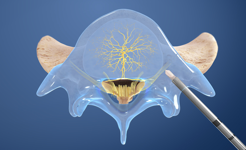Read more about the article Basivertebral Nerve Ablation