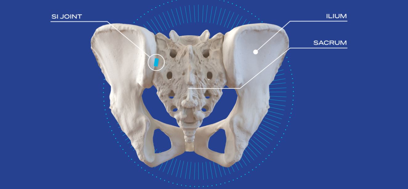 Read more about the article Minimally-Invasive Sacroiliac (SI) Joint Fusion