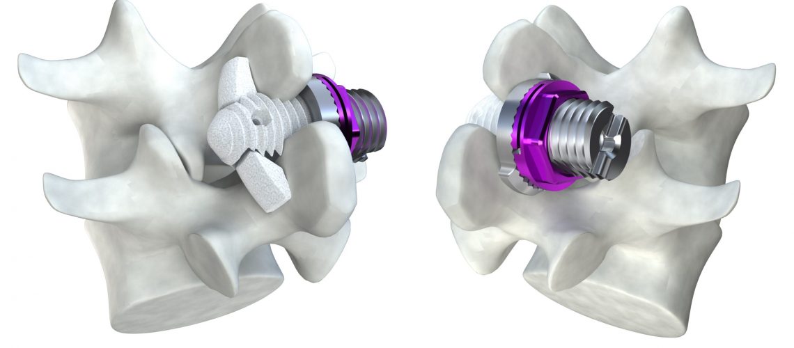 minuteman - minimally invasive spinal fusion - featured